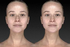vectra xt imaging