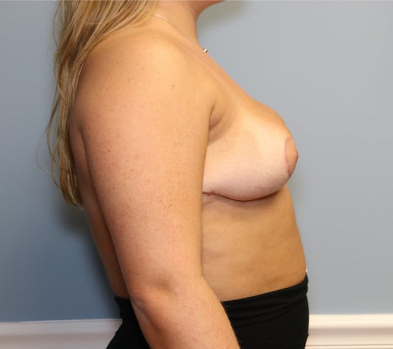 Reduction Before & After Gallery - Patient 107210 - Image 4