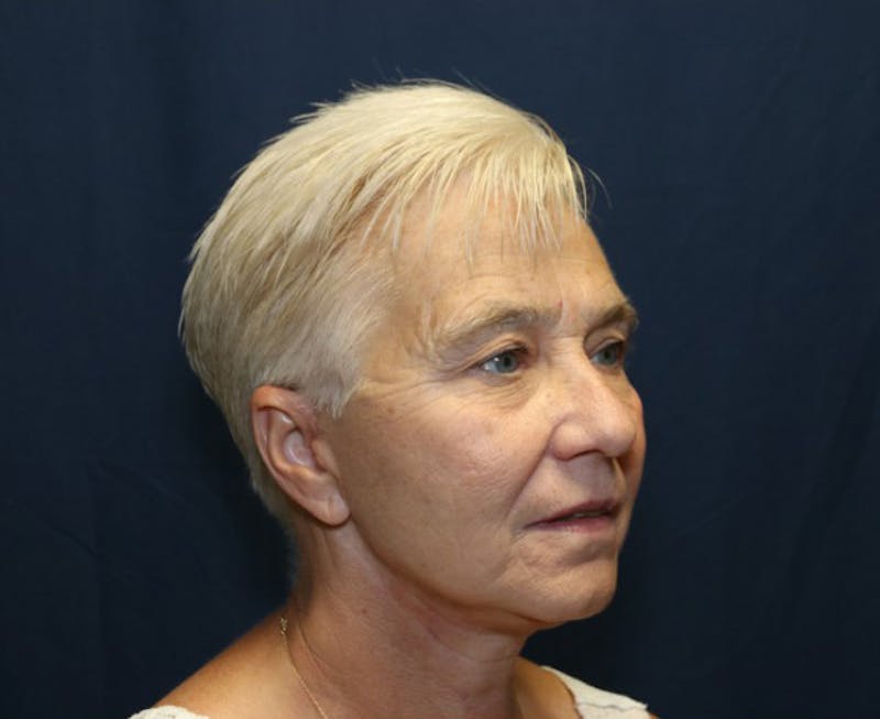 Facelift Before & After Gallery - Patient 936082 - Image 4