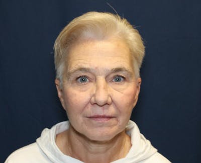 Facelift Before & After Gallery - Patient 936082 - Image 2