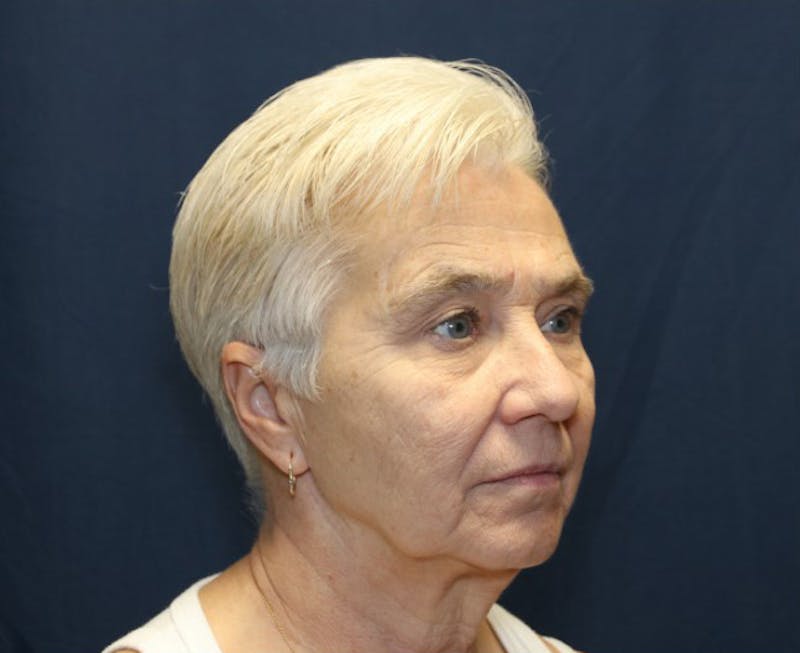 Facelift Before & After Gallery - Patient 936082 - Image 3