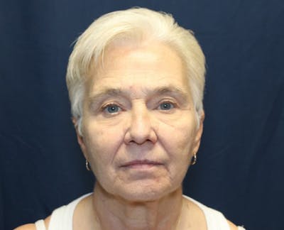 Facelift Before & After Gallery - Patient 936082 - Image 1