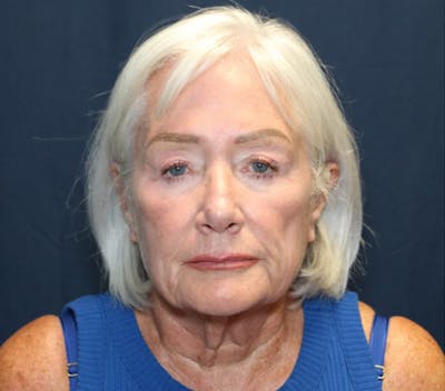 Facelift Before & After Gallery - Patient 415245 - Image 1