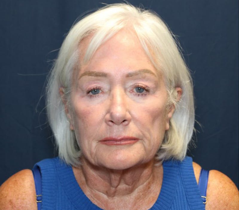Facelift Before & After Gallery - Patient 415245 - Image 1