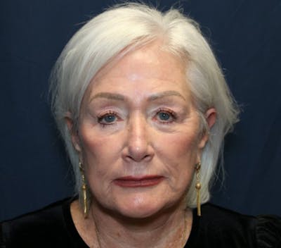Facelift Before & After Gallery - Patient 415245 - Image 2