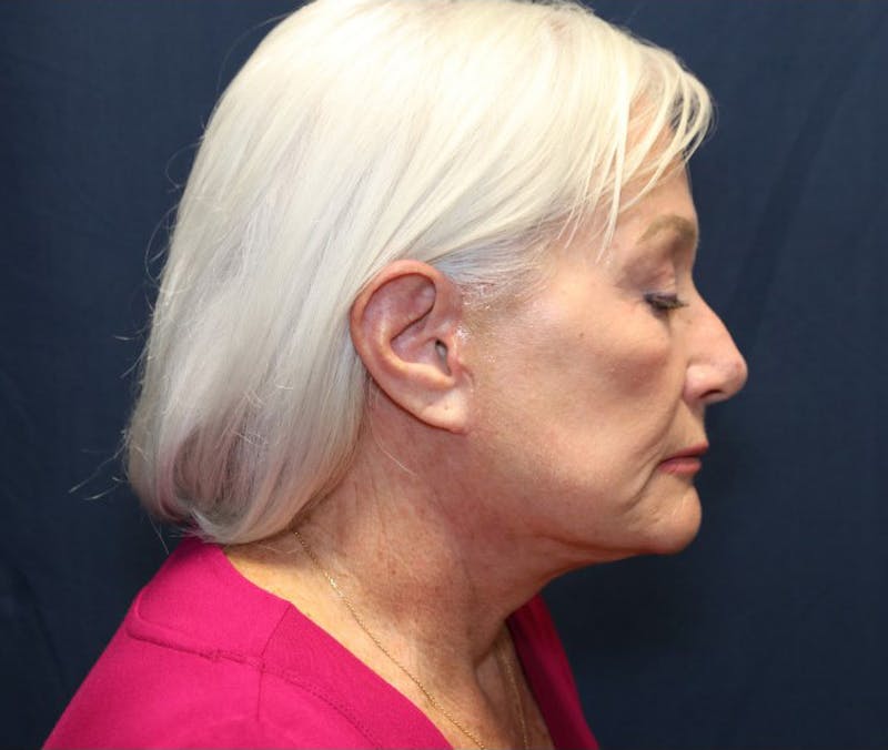 Facelift Before & After Gallery - Patient 415245 - Image 4