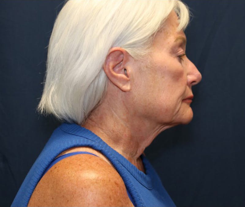 Facelift Before & After Gallery - Patient 415245 - Image 3
