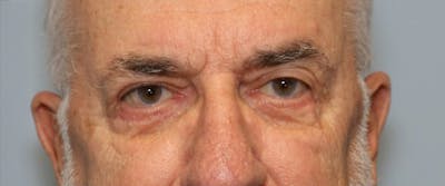 Blepharoplasty (Eyelids) Before & After Gallery - Patient 280299 - Image 2