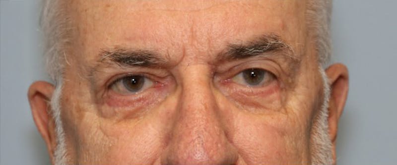 Blepharoplasty (Eyelids) Before & After Gallery - Patient 280299 - Image 2