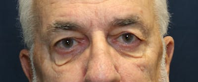 Blepharoplasty (Eyelids) Before & After Gallery - Patient 280299 - Image 1
