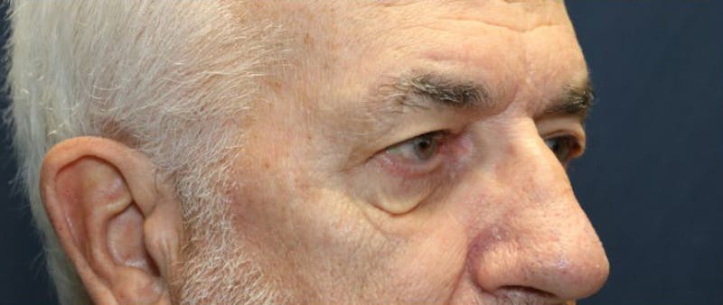 Blepharoplasty (Eyelids) Before & After Gallery - Patient 280299 - Image 3