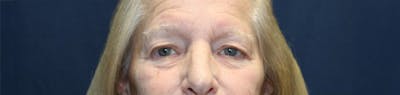 Blepharoplasty (Eyelids) Before & After Gallery - Patient 140234 - Image 1