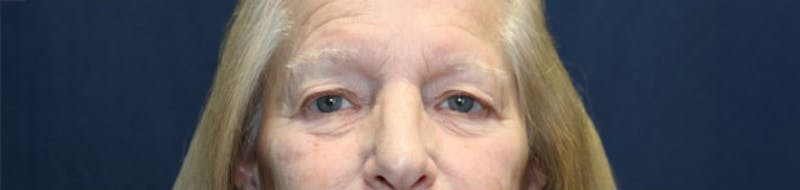 Blepharoplasty (Eyelids) Before & After Gallery - Patient 140234 - Image 1
