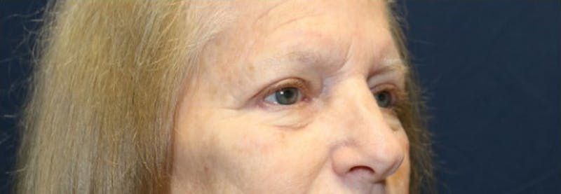 Blepharoplasty (Eyelids) Before & After Gallery - Patient 140234 - Image 4