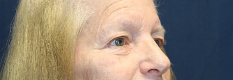 Blepharoplasty (Eyelids) Before & After Gallery - Patient 140234 - Image 3