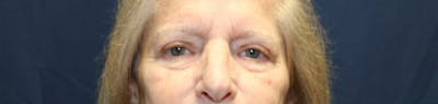 Blepharoplasty (Eyelids) Before & After Gallery - Patient 140234 - Image 2