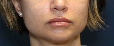 Fillers Before & After Gallery - Patient 321141 - Image 2