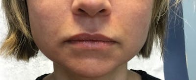 Fillers Before & After Gallery - Patient 321141 - Image 1