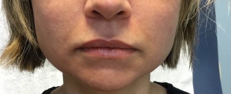 Fillers Before & After Gallery - Patient 321141 - Image 1