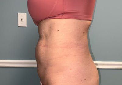 Liposuction Before & After Gallery - Patient 421134 - Image 2