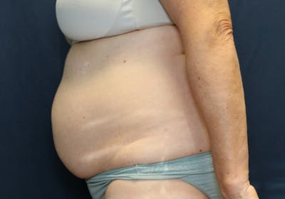 Liposuction Before & After Gallery - Patient 421134 - Image 1
