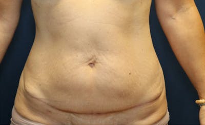 Abdominoplasty/Tummy Tuck Before & After Gallery - Patient 393270 - Image 2