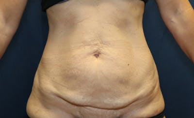 Abdominoplasty/Tummy Tuck Before & After Gallery - Patient 393270 - Image 1