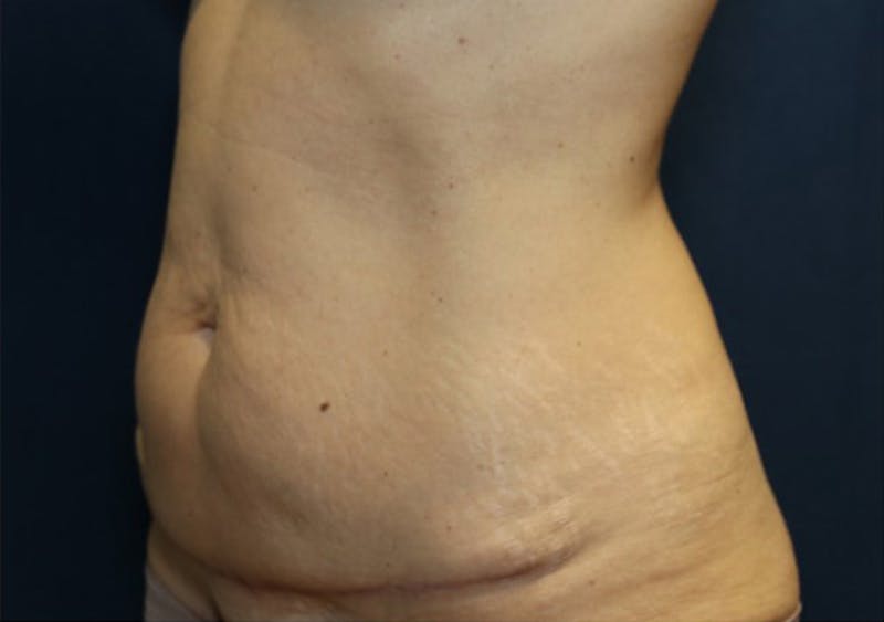 Abdominoplasty/Tummy Tuck Before & After Gallery - Patient 393270 - Image 4