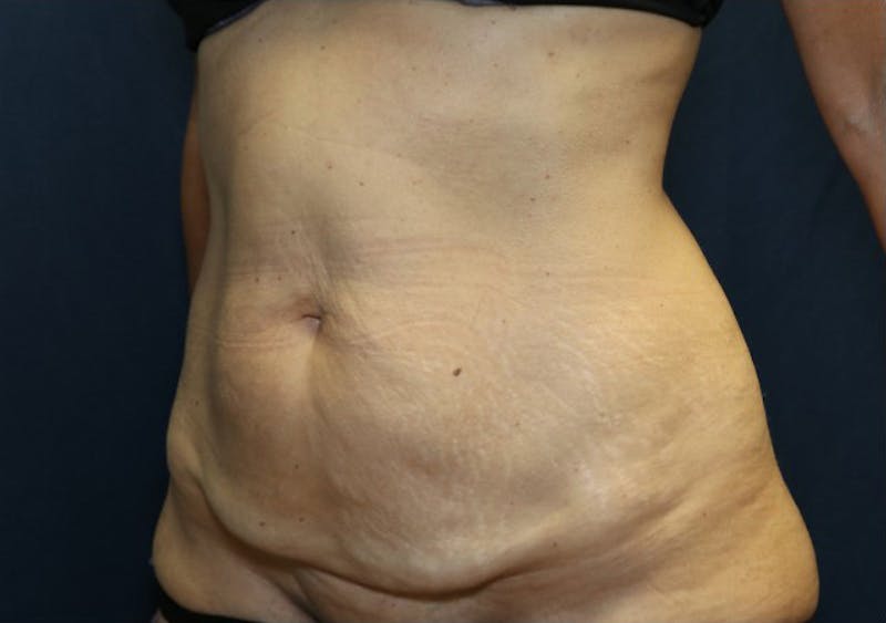 Abdominoplasty/Tummy Tuck Before & After Gallery - Patient 393270 - Image 3
