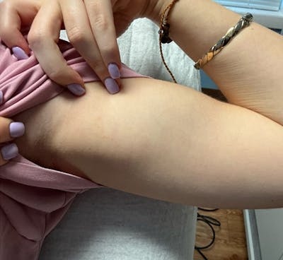 Tattoo Removal Before & After Gallery - Patient 303726 - Image 2