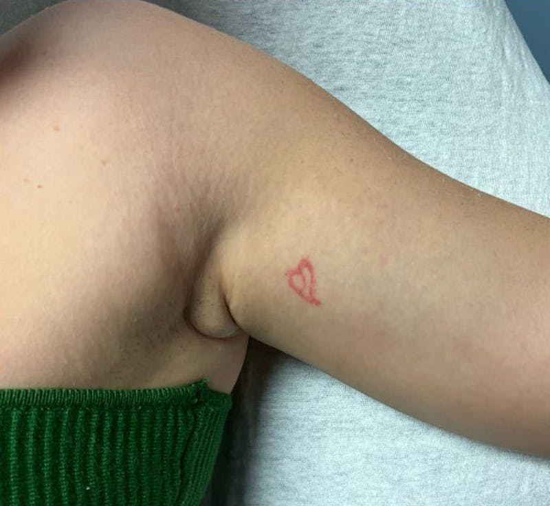 Tattoo Removal Before & After Gallery - Patient 303726 - Image 1