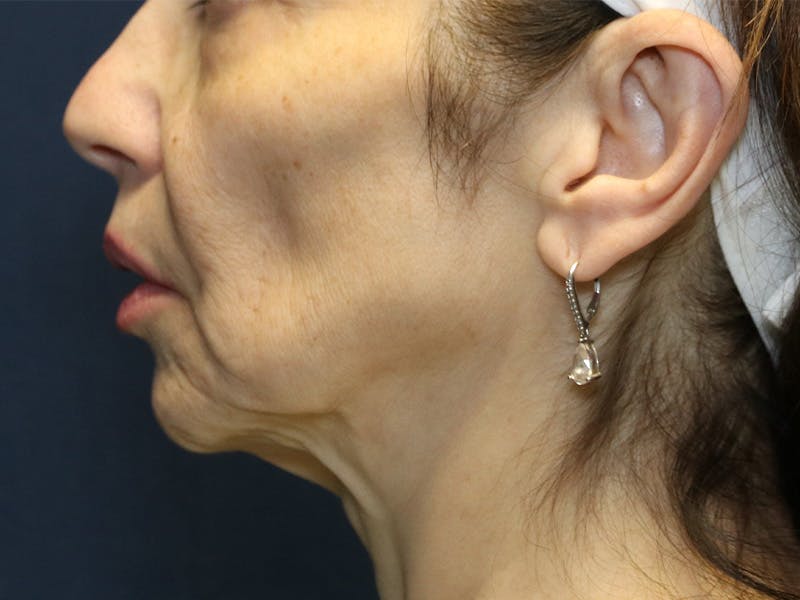Cheek Lift Before & After Gallery - Patient 387550 - Image 3
