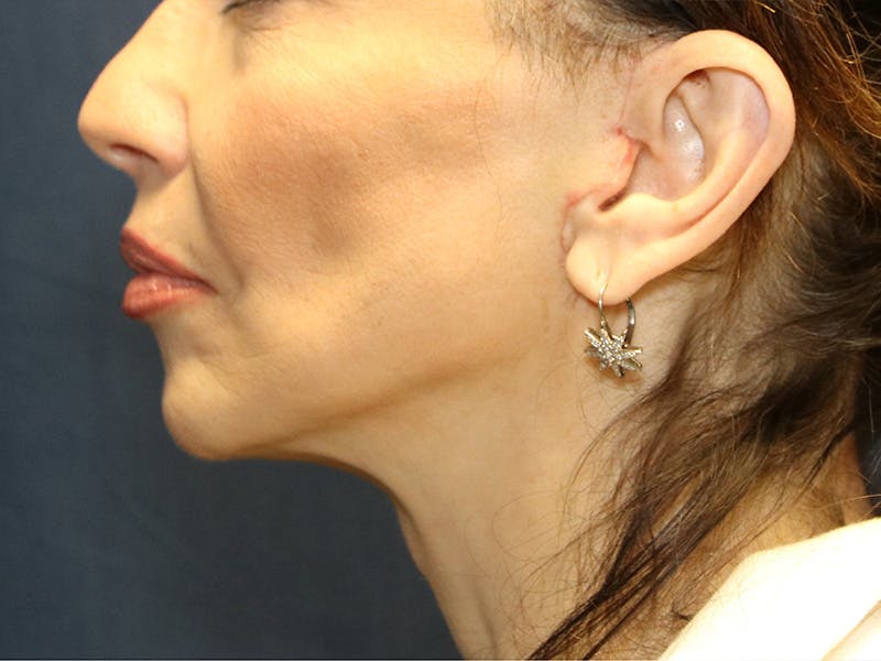 Cheek Lift Before & After Gallery - Patient 387550 - Image 4
