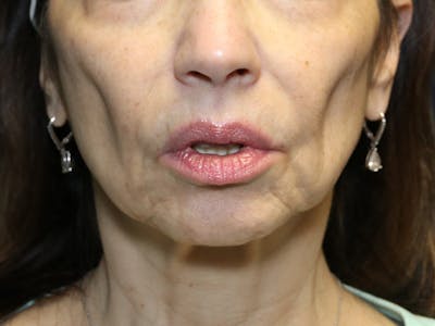 Cheek Lift Before & After Gallery - Patient 387550 - Image 1