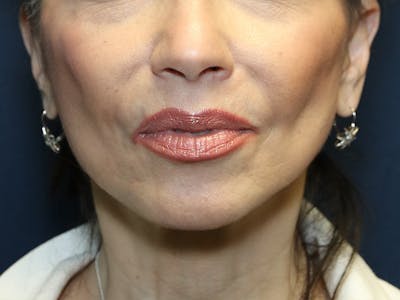 Cheek Lift Before & After Gallery - Patient 387550 - Image 2