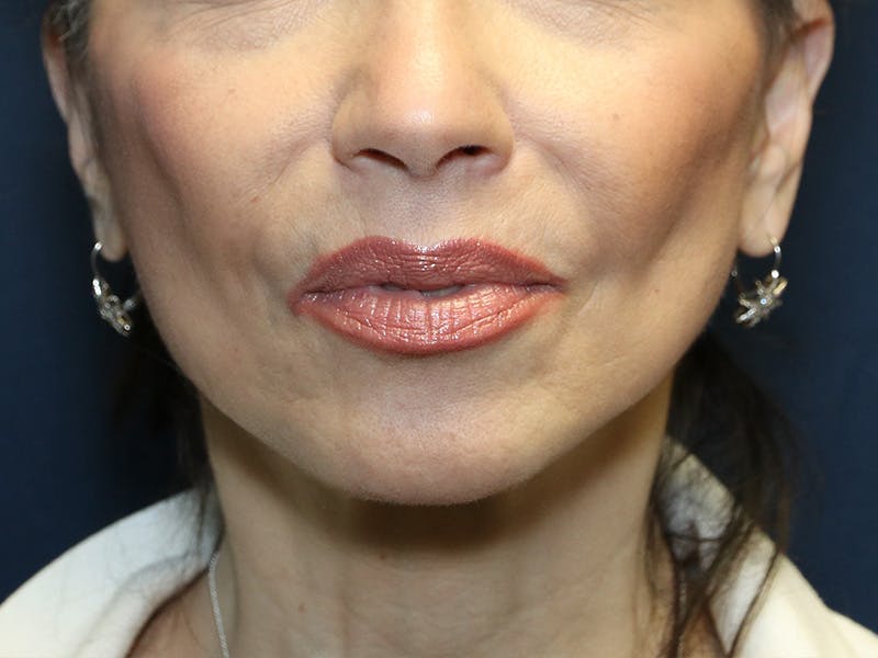 Cheek Lift Before & After Gallery - Patient 387550 - Image 2