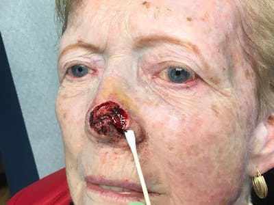Face Reconstructive Before & After Gallery - Patient 326327 - Image 1