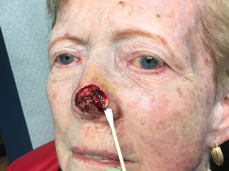 Face Reconstructive Before & After Gallery - Patient 326327 - Image 1