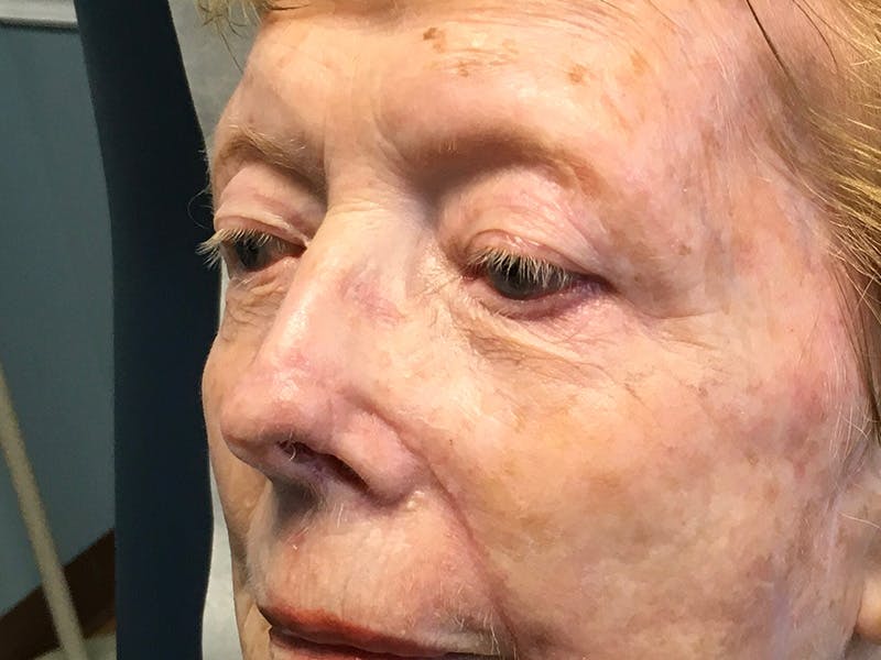 Face Reconstructive Before & After Gallery - Patient 326327 - Image 2