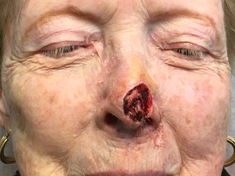 Face Reconstructive Before & After Gallery - Patient 326327 - Image 3