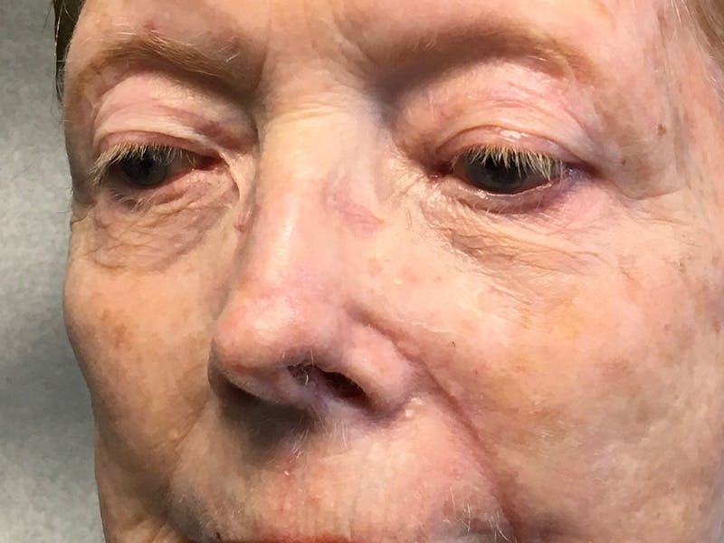 Face Reconstructive Before & After Gallery - Patient 326327 - Image 4