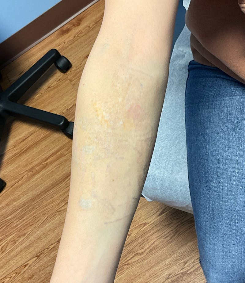 Tattoo Removal Before & After Gallery - Patient 139056 - Image 2