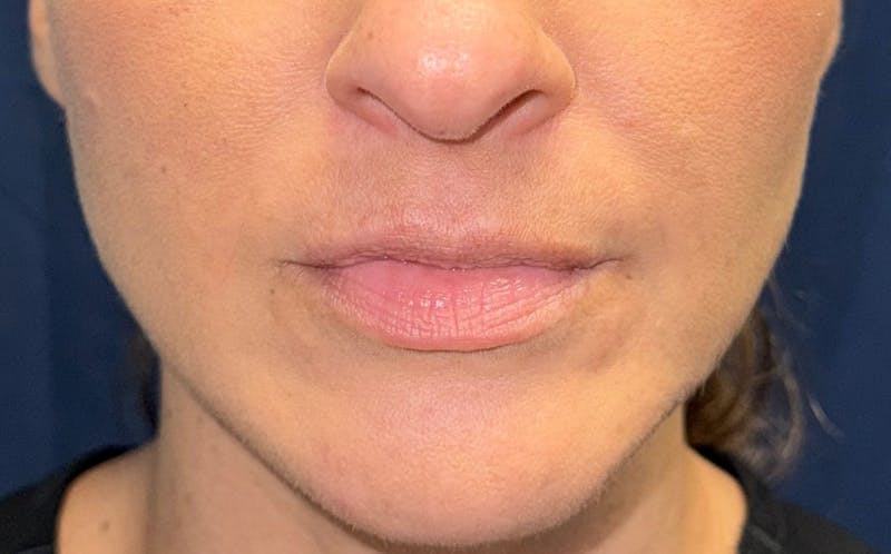 Fillers Before & After Gallery - Patient 423708 - Image 1
