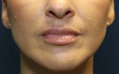Fillers Before & After Gallery - Patient 423708 - Image 2