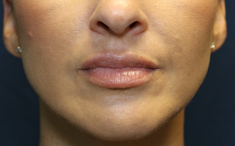 Fillers Before & After Gallery - Patient 423708 - Image 2