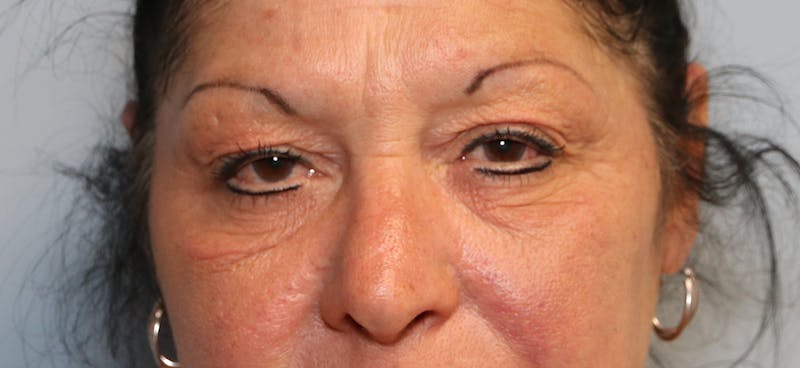 Skin Rejuvenation Before & After Gallery - Patient 187026 - Image 2