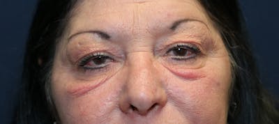 Skin Rejuvenation Before & After Gallery - Patient 187026 - Image 1
