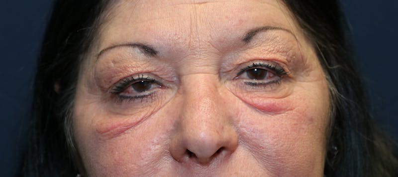 Skin Rejuvenation Before & After Gallery - Patient 187026 - Image 1