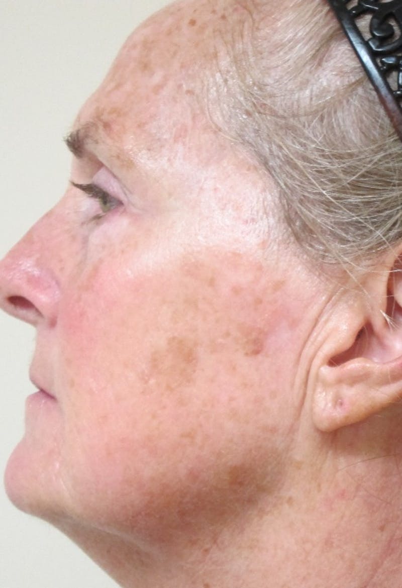 Red/Brown Spot Removal Before & After Gallery - Patient 103156 - Image 2