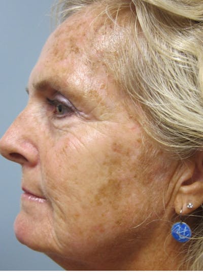 Red/Brown Spot Removal Before & After Gallery - Patient 103156 - Image 1